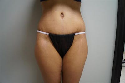 Tummy Tuck Before & After Gallery - Patient 155750 - Image 2