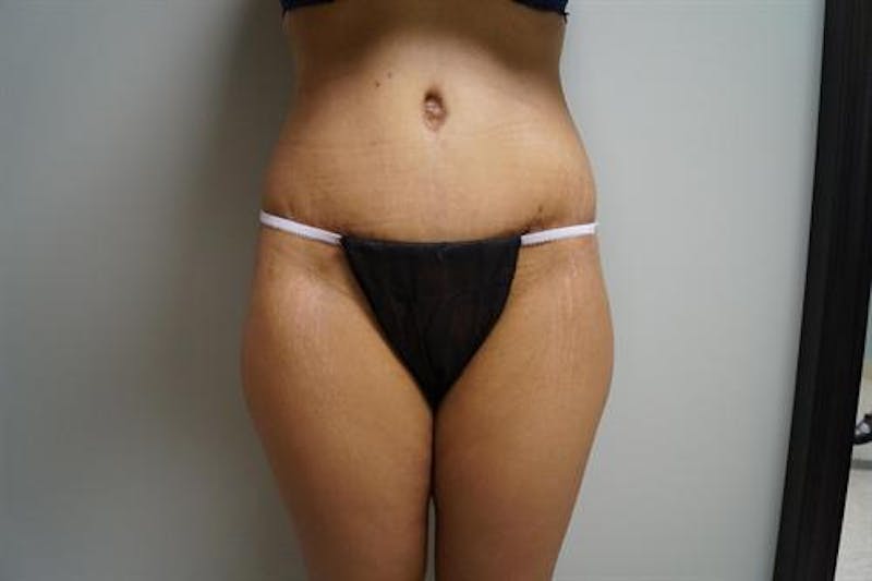 Tummy Tuck Before & After Gallery - Patient 155750 - Image 2