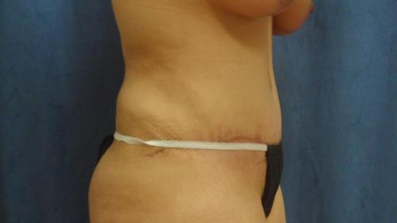 Tummy Tuck Before & After Gallery - Patient 112849 - Image 4