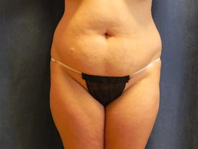 Tummy Tuck Before & After Gallery - Patient 192019 - Image 1