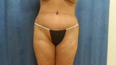 Tummy Tuck Before & After Gallery - Patient 192019 - Image 2