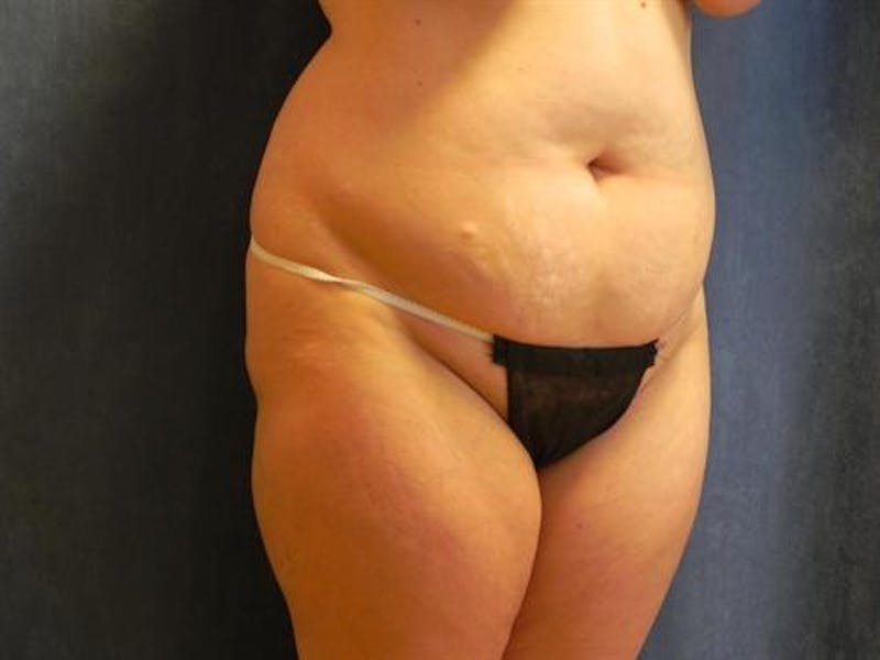 Tummy Tuck Before & After Gallery - Patient 192019 - Image 3