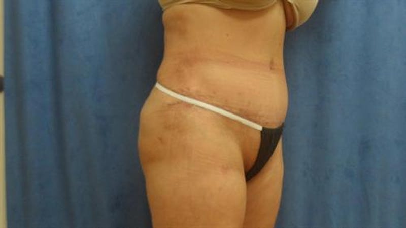 Tummy Tuck Before & After Gallery - Patient 192019 - Image 4