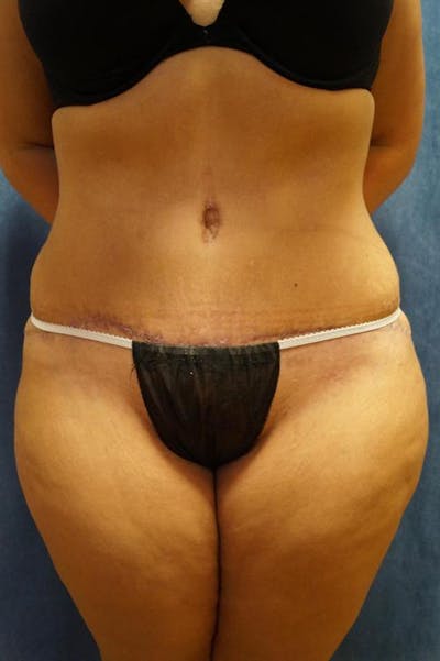 Tummy Tuck Before & After Gallery - Patient 122059 - Image 2