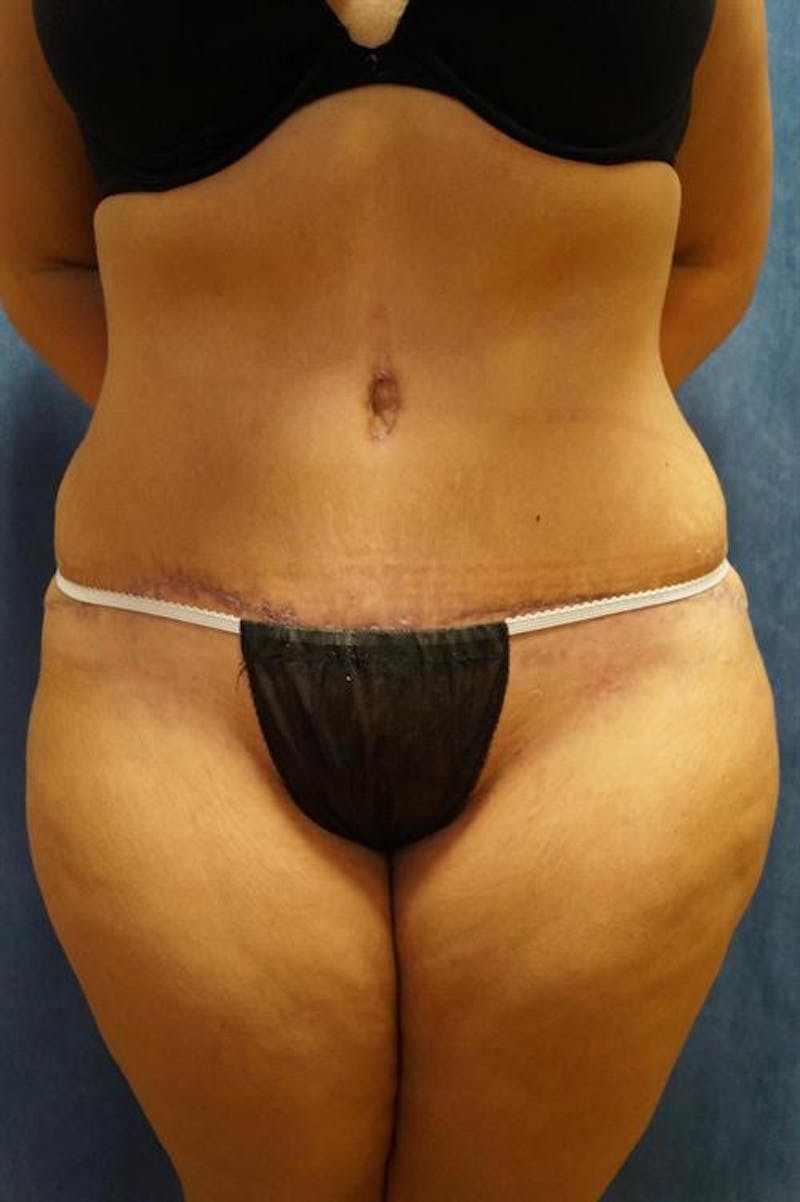 Tummy Tuck Before & After Gallery - Patient 122059 - Image 2
