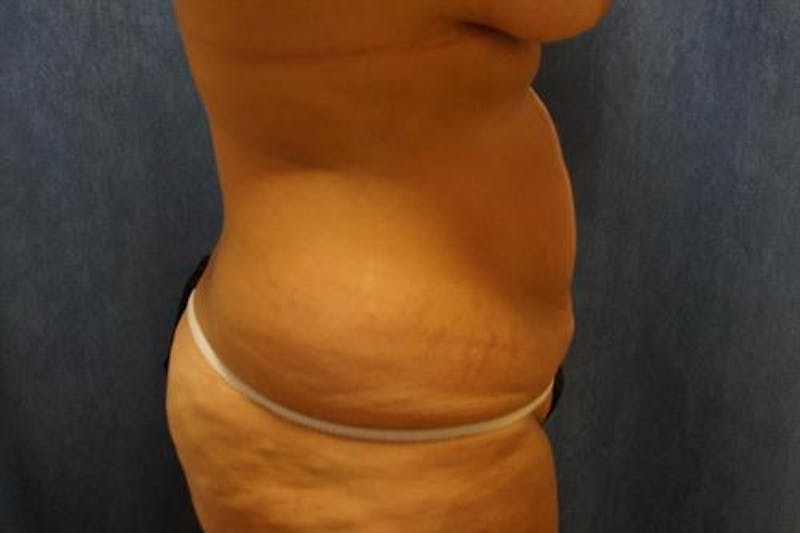 Tummy Tuck Before & After Gallery - Patient 122059 - Image 3