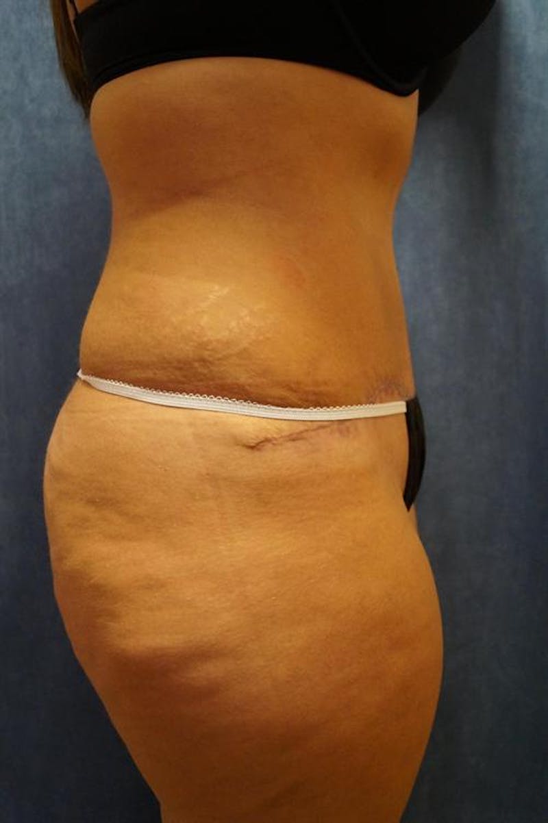 Tummy Tuck Before & After Gallery - Patient 122059 - Image 4