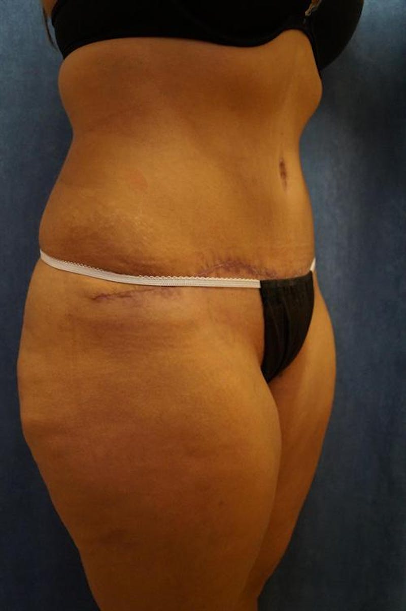 Tummy Tuck Before & After Gallery - Patient 122059 - Image 6