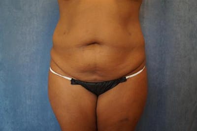 Tummy Tuck Before & After Gallery - Patient 643106 - Image 1