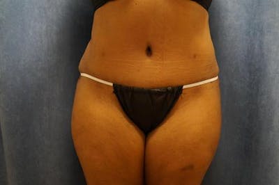 Tummy Tuck Before & After Gallery - Patient 643106 - Image 2
