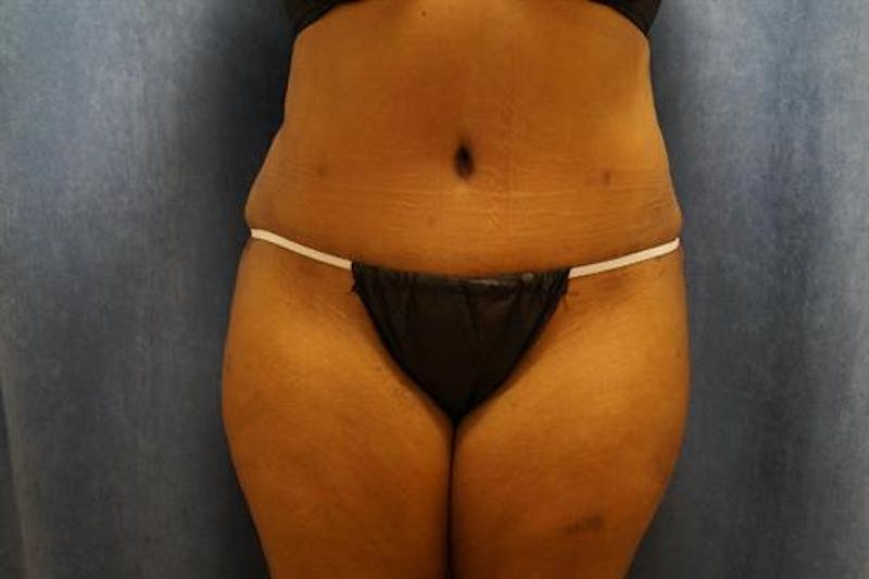 Tummy Tuck Before & After Gallery - Patient 643106 - Image 2
