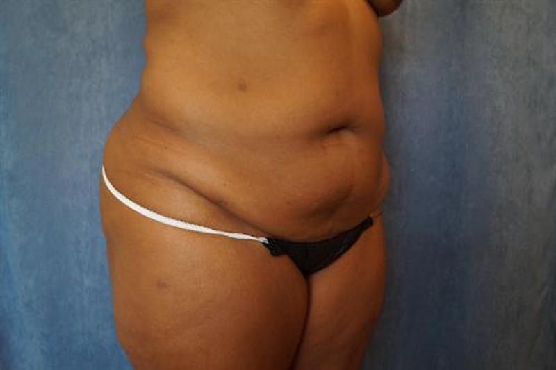 Tummy Tuck Before & After Gallery - Patient 643106 - Image 3