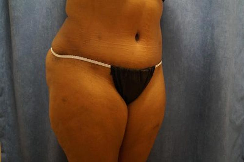 Tummy Tuck Before & After Gallery - Patient 643106 - Image 4