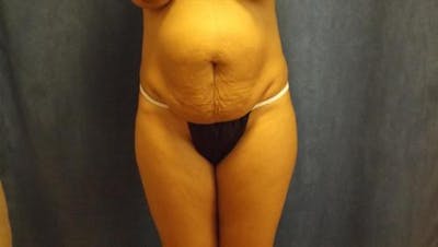 Tummy Tuck Before & After Gallery - Patient 212280 - Image 1