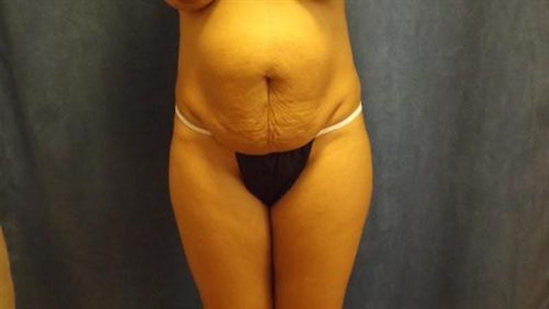 Tummy Tuck Before & After Gallery - Patient 212280 - Image 1