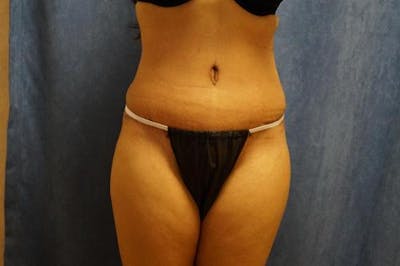 Tummy Tuck Before & After Gallery - Patient 212280 - Image 2