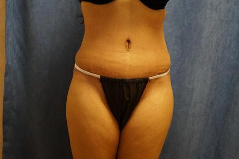 Tummy Tuck Before & After Gallery - Patient 212280 - Image 2