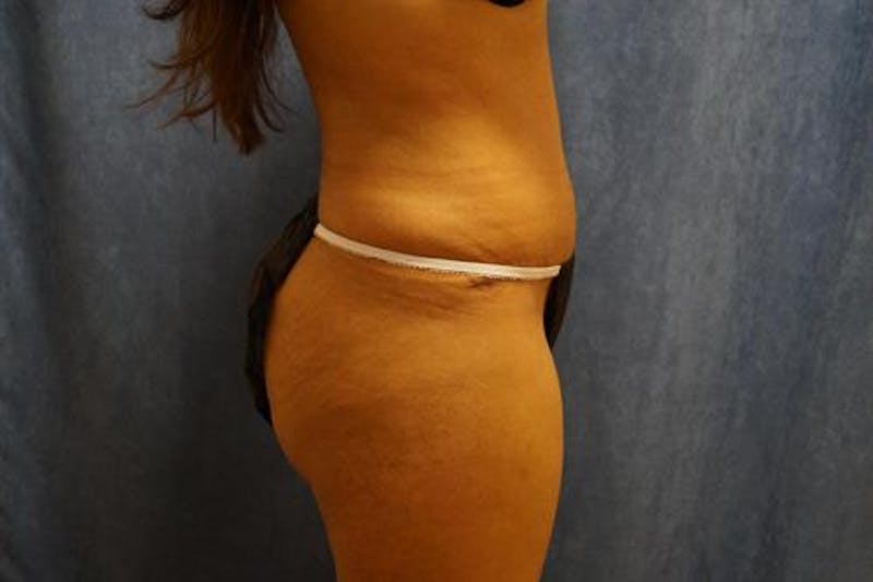 Tummy Tuck Before & After Gallery - Patient 212280 - Image 4