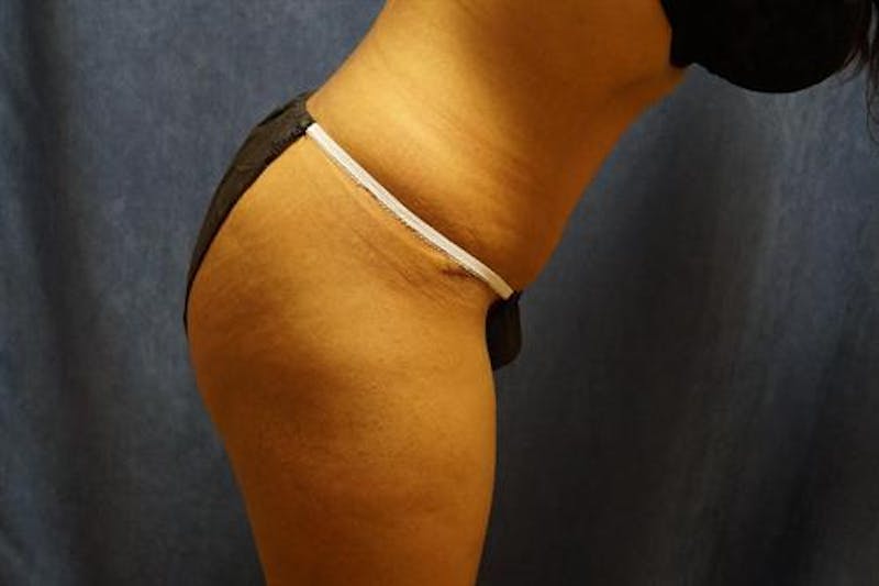 Tummy Tuck Before & After Gallery - Patient 212280 - Image 6