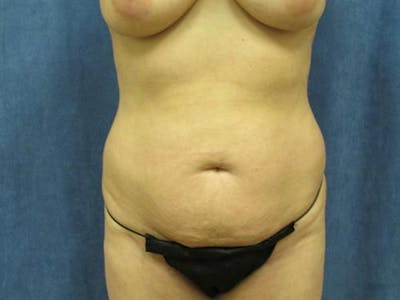 Tummy Tuck Before & After Gallery - Patient 263867 - Image 1