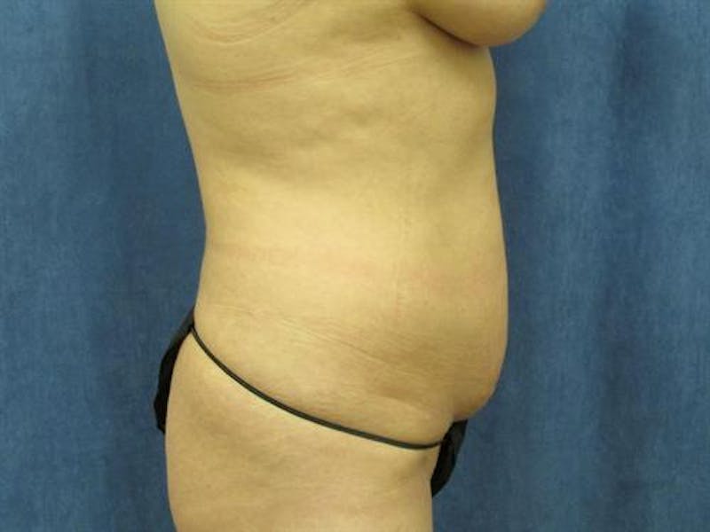 Tummy Tuck Before & After Gallery - Patient 263867 - Image 3