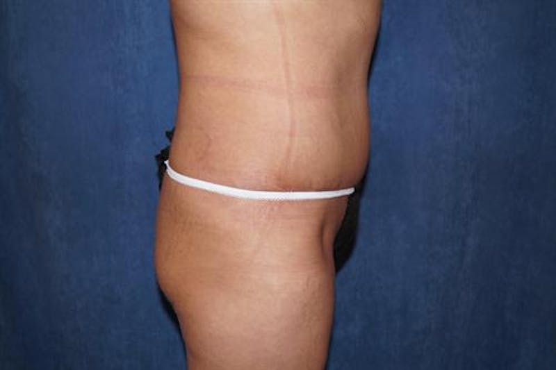 Tummy Tuck Before & After Gallery - Patient 263867 - Image 4