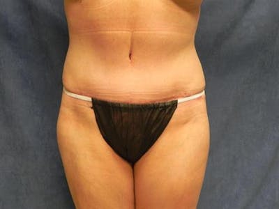 Tummy Tuck Before & After Gallery - Patient 136396 - Image 2
