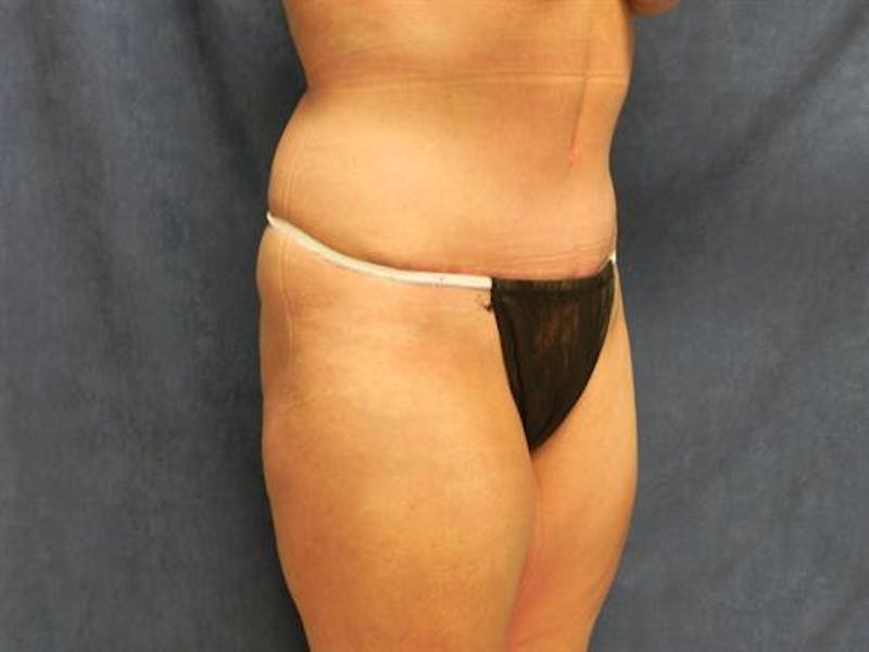 Tummy Tuck Before & After Gallery - Patient 136396 - Image 4