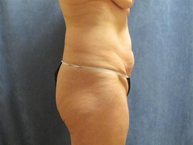 Tummy Tuck Before & After Gallery - Patient 136396 - Image 5