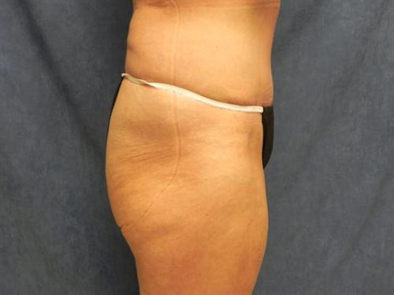 Tummy Tuck Before & After Gallery - Patient 136396 - Image 6