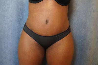 Tummy Tuck Before & After Gallery - Patient 135386 - Image 2