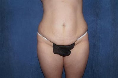 Tummy Tuck Before & After Gallery - Patient 373211 - Image 1