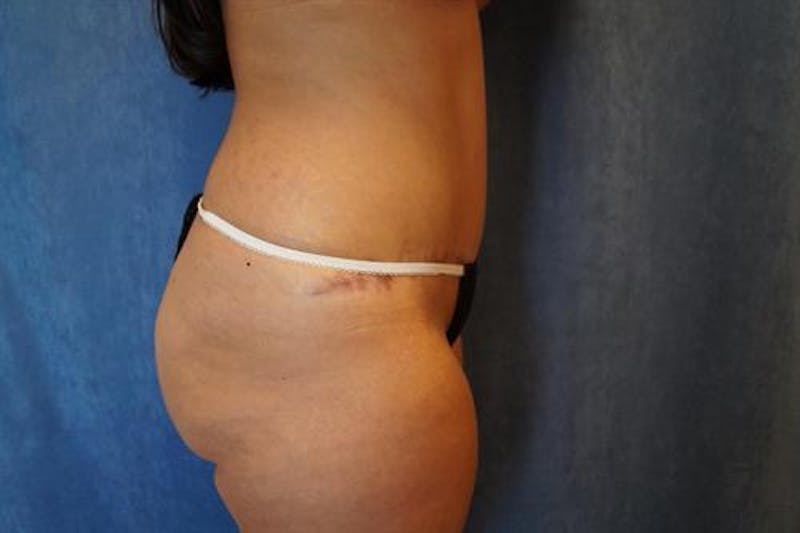 Tummy Tuck Before & After Gallery - Patient 373211 - Image 4