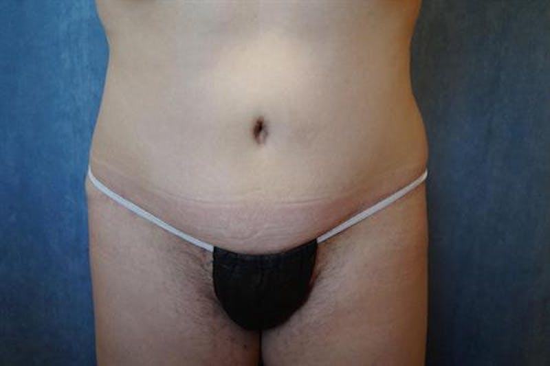 Tummy Tuck Before & After Gallery - Patient 307565 - Image 2