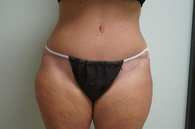 Tummy Tuck Before & After Gallery - Patient 193547 - Image 2