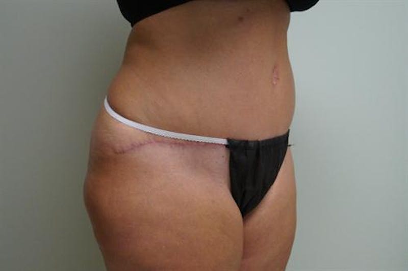 Tummy Tuck Before & After Gallery - Patient 193547 - Image 4