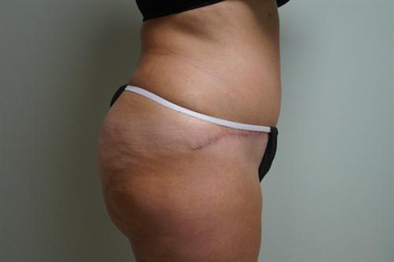 Tummy Tuck Before & After Gallery - Patient 193547 - Image 6