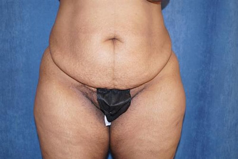 Tummy Tuck Before & After Gallery - Patient 425331 - Image 1