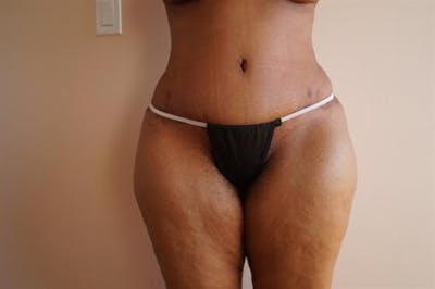 Tummy Tuck Before & After Gallery - Patient 425331 - Image 2