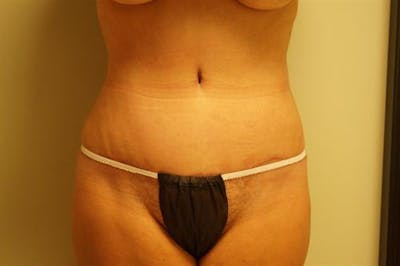 Tummy Tuck Before & After Gallery - Patient 296977 - Image 2