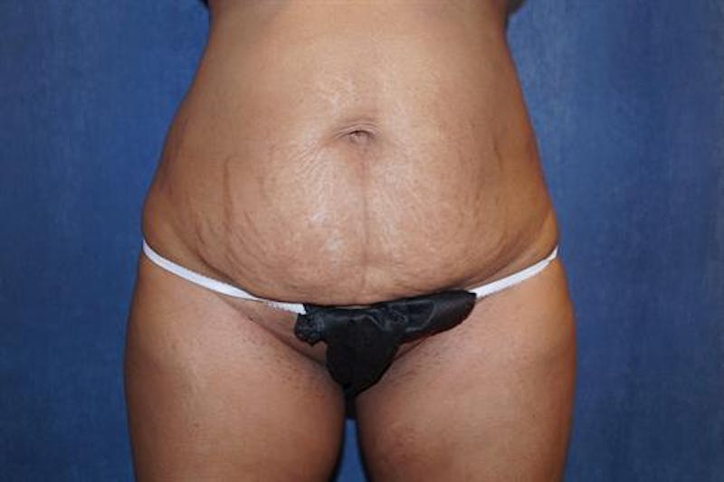 Tummy Tuck Before & After Gallery - Patient 873106 - Image 1