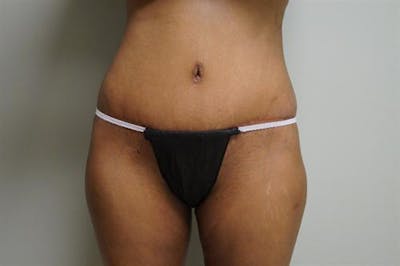 Tummy Tuck Before & After Gallery - Patient 873106 - Image 2
