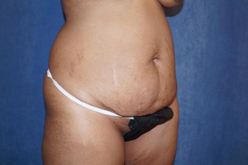 Tummy Tuck Before & After Gallery - Patient 873106 - Image 3