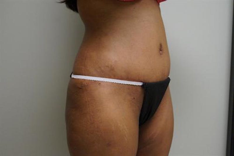Tummy Tuck Before & After Gallery - Patient 873106 - Image 4