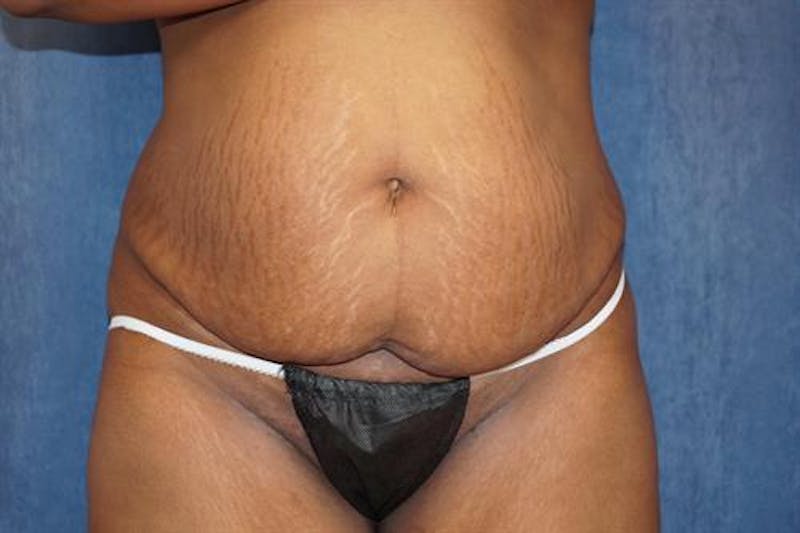Tummy Tuck Before & After Gallery - Patient 181425 - Image 1