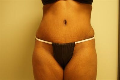 Tummy Tuck Before & After Gallery - Patient 181425 - Image 2