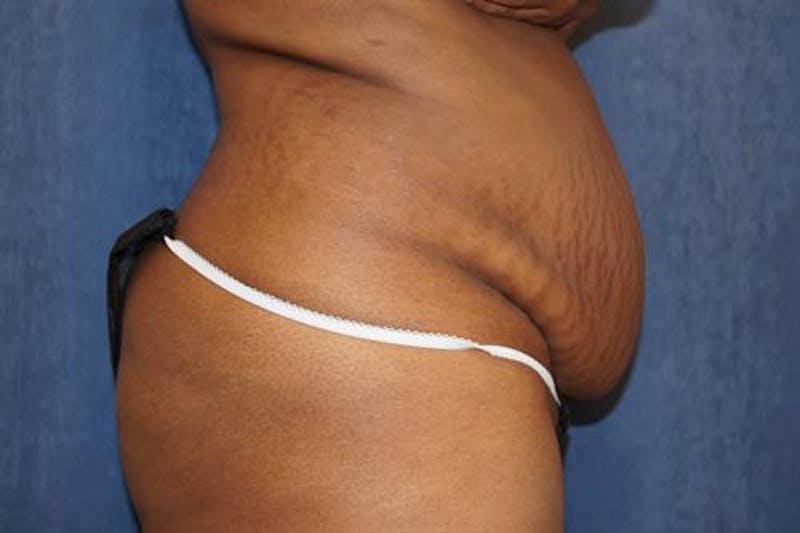 Tummy Tuck Before & After Gallery - Patient 181425 - Image 3