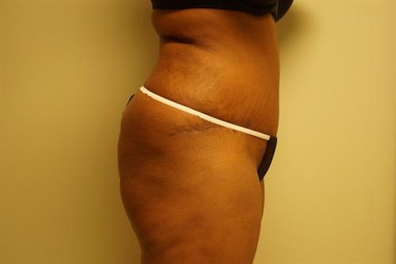 Tummy Tuck Before & After Gallery - Patient 181425 - Image 4