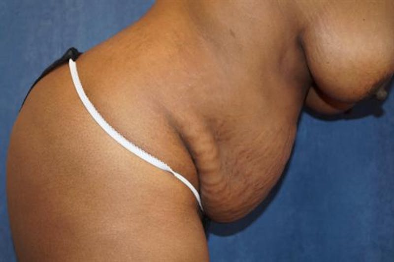 Tummy Tuck Before & After Gallery - Patient 181425 - Image 5