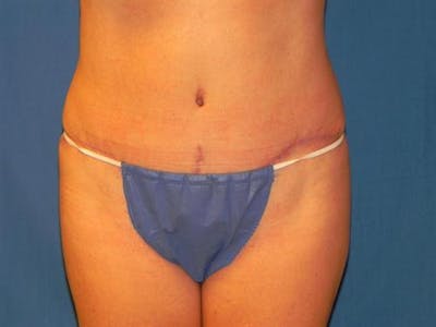 Tummy Tuck Before & After Gallery - Patient 358683 - Image 2